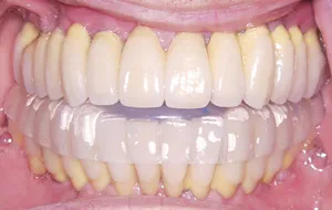 Case Study 3-Total Implant Reconstruction implant restorations placed