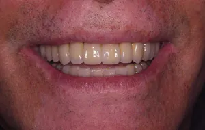 Case Study 3-Total Implant Reconstruction smile