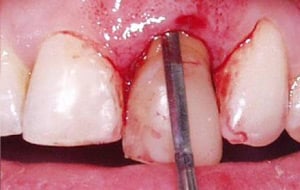Case Study 2-Ridge Preservation