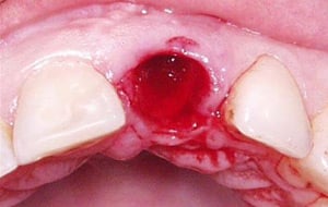 Case Study 2-Ridge Preservation