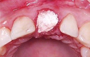 Case Study 2-Ridge Preservation
