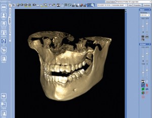 3d-imaging-advanced technology at Periodontal Specialists