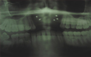 Case Study 1- Bone Block Graft
