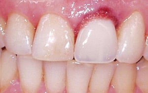 Case Study 2-Ridge Preservation