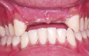 Case Study 1- Bone Block Graft