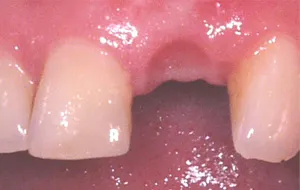 Case Study 2-Ridge Preservation