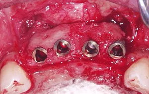 Case Study 1- Bone Block Graft