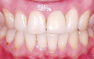 Case Study 2-Ridge Preservation