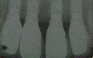 Case Study 1- Bone Block Graft xray
