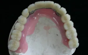 Case Study 3-Total Implant Reconstruction implant restorations placed