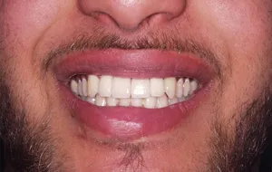 Case Study 1- Bone Block Graft Smile after Treatment