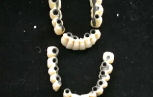 Case Study 3-Total Implant Reconstruction photo of implant restorations