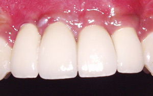 Case Study 1- Bone Block Graft Front teeth after Treatment