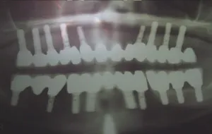 Case Study 3-Total Implant Reconstruction xray 