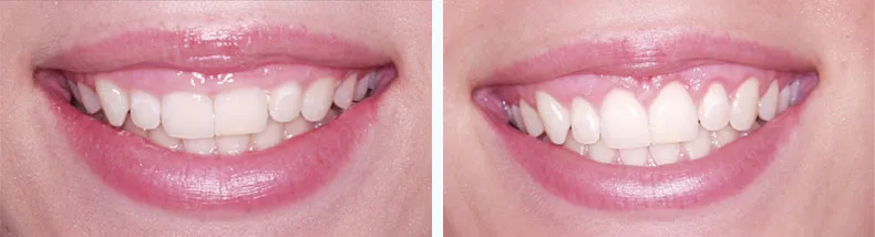 Before & After Crown Lengthening