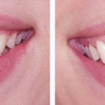Before & After Crown Lengthening