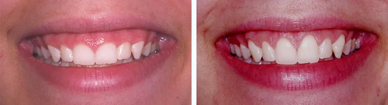 Before & After Crown Lengthening case study