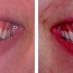 Before & After Crown Lengthening case study