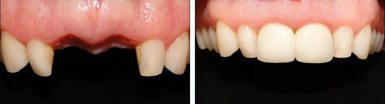 Before & After Dental Implants Case Study 7