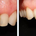 Before & After Dental Implants Case Study 7