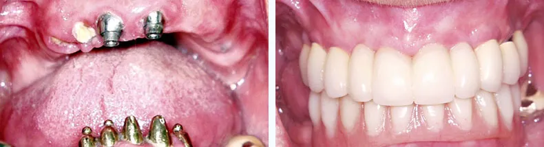 Before & After Dental Implants Case Study 10