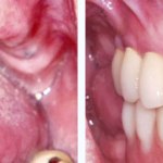 Before & After Dental Implants Case Study 10