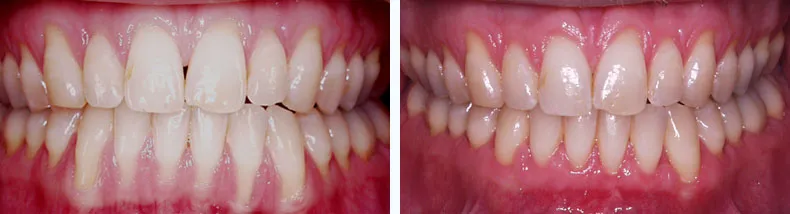 Before & After Case Study 13