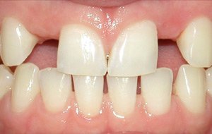 Before-Beautiful Teeth through Implants Success Story