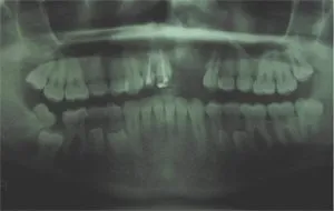 Case Study 1- Bone Block Graft Xray