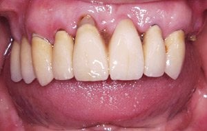 Case Study 3-Total Implant Reconstruction