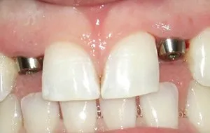 Implant Posts Placed-Beautiful Teeth through Implants Success Story