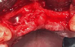 Case Study 1- Bone Block Graft