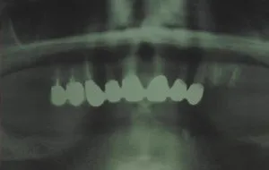 Case Study 3-Total Implant Reconstruction
