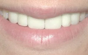 After-Beautiful Teeth through Implants Success Story