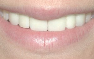 After-Beautiful Teeth through Implants Success Story