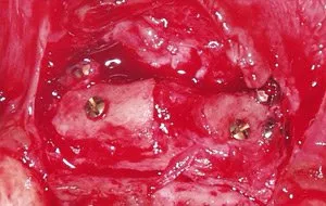 Case Study 1- Bone Block Graft