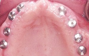 Case Study 3-Total Implant Reconstruction implants placed