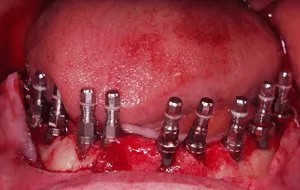 Case Study 3-Total Implant Reconstruction implants placed