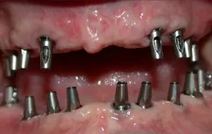 Case Study 3-Total Implant Reconstruction implants placed