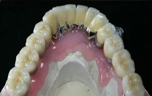 Case Study 3-Total Implant Reconstruction implant restorations placed