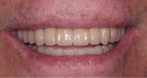 Smiling mouth after dental implants Case 1