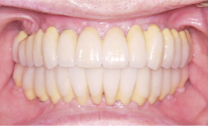 Mouth with full dental implants Case 1
