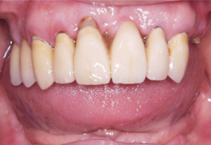 Before Dental Implants Case 1