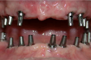 Mouth with Teeth removed and dental implant posts placed Case 1