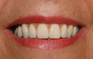 Smiling mouth after treatment at Periodontal Specialists Case 2
