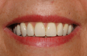 Smiling mouth after treatment at Periodontal Specialists Case 2