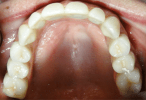 Mouth after treatment at Periodontal Specialists Case 2