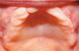 Mouth before treatment at Periodontal Specialists Case 2