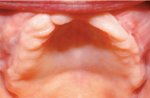 Mouth before treatment at Periodontal Specialists Case 2