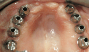 Mouth during treatment at Periodontal Specialists Case 2